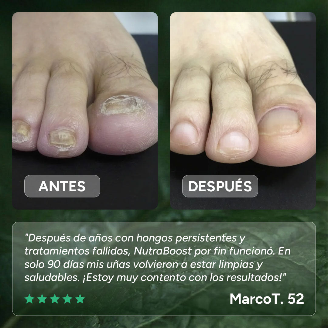 Gel para el Tratamiento de Hongos en las Uñas