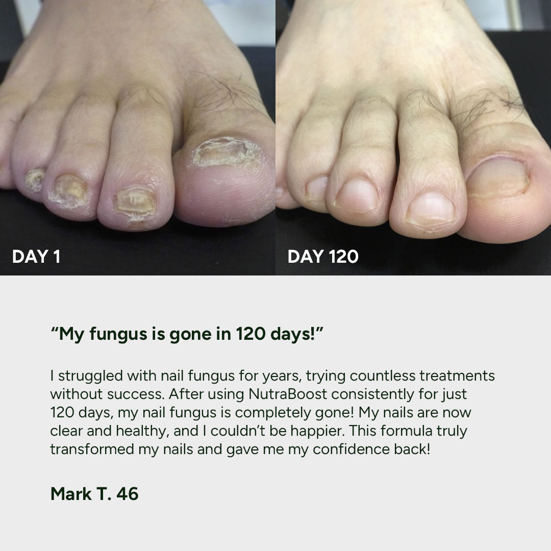 Nail Fungus Treatment Gel – NutraBoost